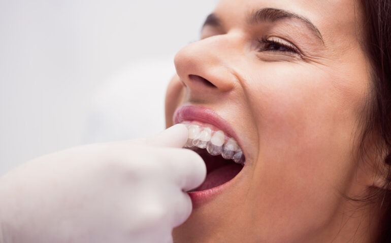 dentist-assisting-female-patient-wear-braces