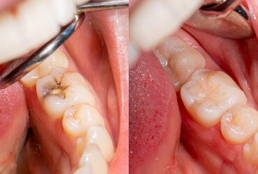 Fillings/ Restorations