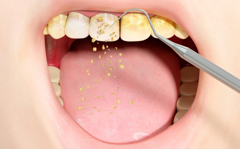 tartar-removal-human-teeth-by-conventional-periodontal-therapy-using-dental-tools